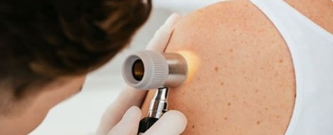 Faliciliter l'accès à un avis en téléexpertise dermatologie et sécuriser la prise en charge des lésions suspectes