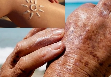 Campagne de prévention "Solaire" dans le cadre de l'accès à la détection précoce du mélanome